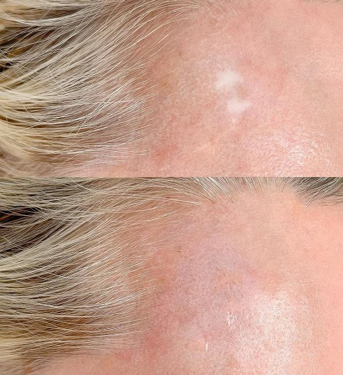 Dermopigmentation